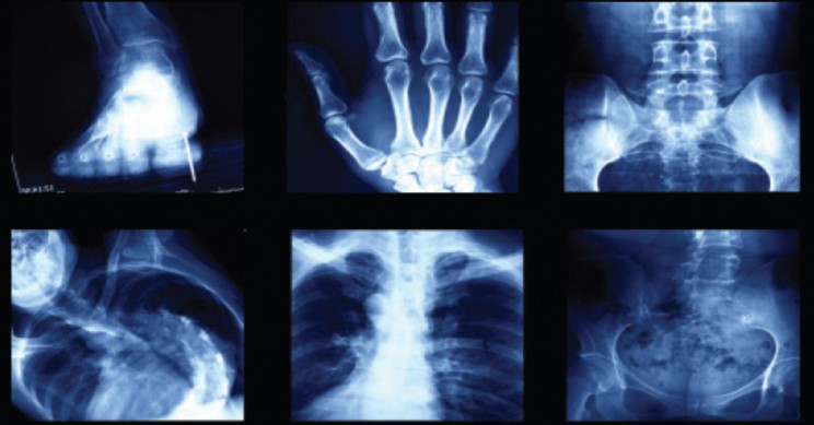 myths about x rays collage